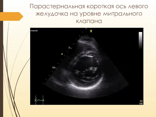 Парастернальная короткая ось левого желудочка на уровне митрального клапана