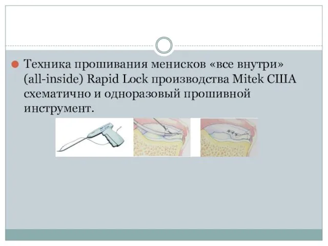 Техника прошивания менисков «все внутри» (all-inside) Rapid Lock производства Mitek США схематично и одноразовый прошивной инструмент.