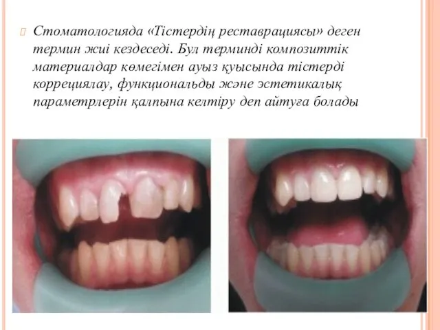 Стоматологияда «Тістердің реставрациясы» деген термин жиі кездеседі. Бул терминді композиттік