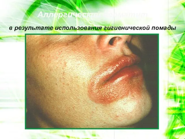 Аллергический дерматит в результате использования гигиенической помады
