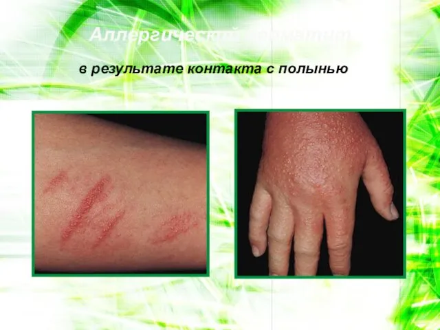 Аллергический дерматит в результате контакта с полынью