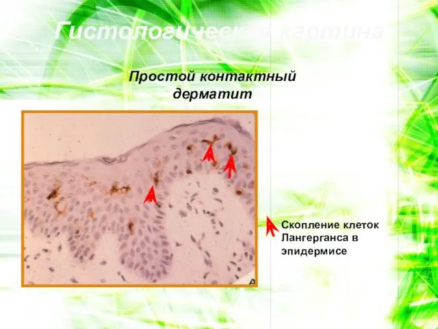 Гистологическая картина Простой контактный дерматит Скопление клеток Лангерганса в эпидермисе