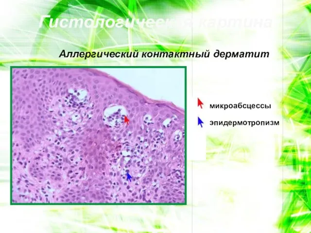Гистологическая картина Аллергический контактный дерматит микроабсцессы эпидермотропизм