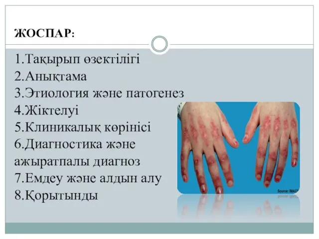 ЖОСПАР: 1.Тақырып өзектілігі 2.Анықтама 3.Этиология және патогенез 4.Жіктелуі 5.Клиникалық көрінісі