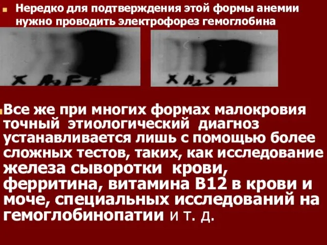 Нередко для подтверждения этой формы анемии нужно проводить электрофорез гемоглобина