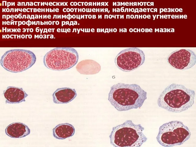 При апластических состояниях изменяются количественные соотношения, наблюдается резкое преобладание лимфоцитов