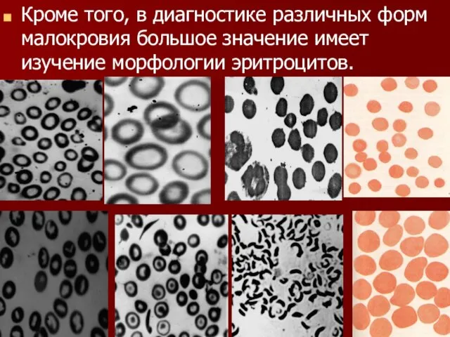 Кроме того, в диагностике различных форм малокровия большое значение имеет изучение морфологии эритроцитов.