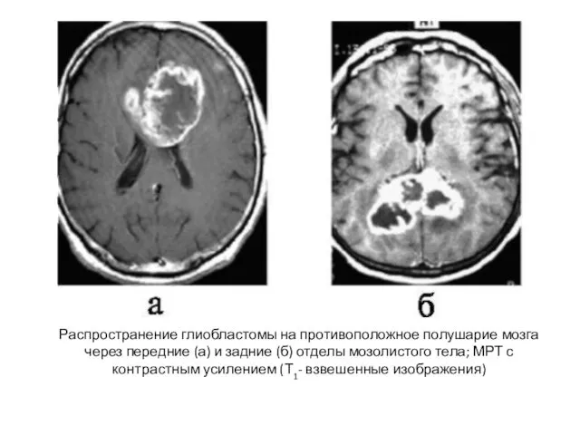 Распространение глиобластомы на противоположное полушарие мозга через передние (а) и