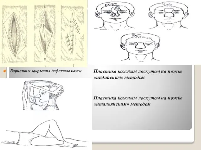 Варианты закрытия дефектов кожи Пластика кожным лоскутом на ножке «индийским»