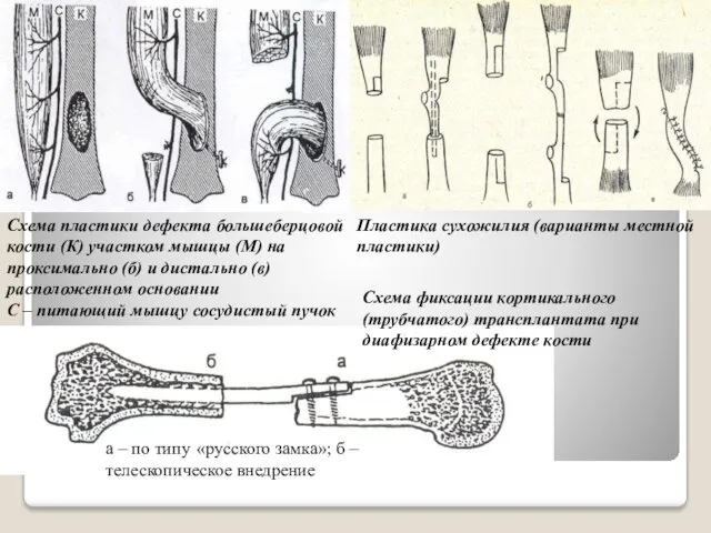 Схема пластики дефекта большеберцовой кости (К) участком мышцы (М) на