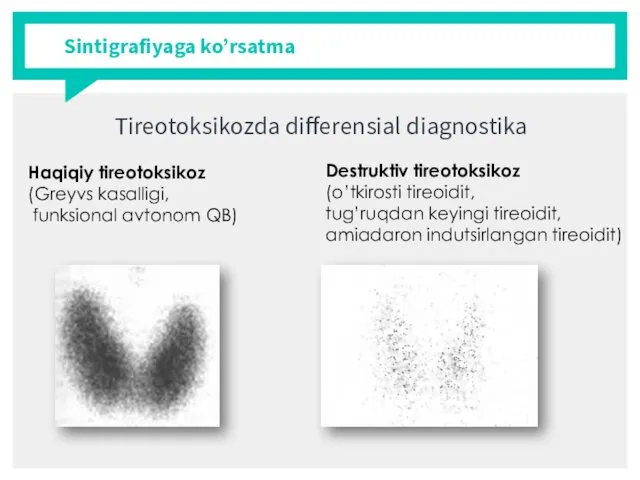 Sintigrafiyaga ko’rsatma Tireotoksikozda differensial diagnostika Haqiqiy tireotoksikoz (Greyvs kasalligi, funksional