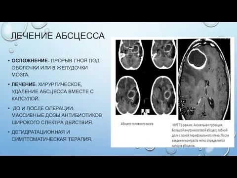 ЛЕЧЕНИЕ АБСЦЕССА ОСЛОЖНЕНИЕ- ПРОРЫВ ГНОЯ ПОД ОБОЛОЧКИ ИЛИ В ЖЕЛУДОЧКИ