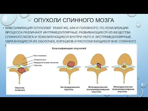 ОПУХОЛИ СПИННОГО МОЗГА КЛАССИФИКАЦИЯ ОПУХОЛЕЙ ТАКАЯ ЖЕ, КАК И ГОЛОВНОГО.