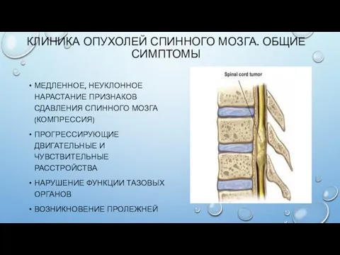 КЛИНИКА ОПУХОЛЕЙ СПИННОГО МОЗГА. ОБЩИЕ СИМПТОМЫ МЕДЛЕННОЕ, НЕУКЛОННОЕ НАРАСТАНИЕ ПРИЗНАКОВ