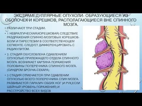 ЭКСТРАМЕДУЛЛЯРНЫЕ ОПУХОЛИ- ОБРАЗУЮЩИЕСЯ ИЗ ОБОЛОЧЕК И КОРЕШКОВ, РАСПОЛАГАЮЩИЕСЯ ВНЕ СПИННОГО