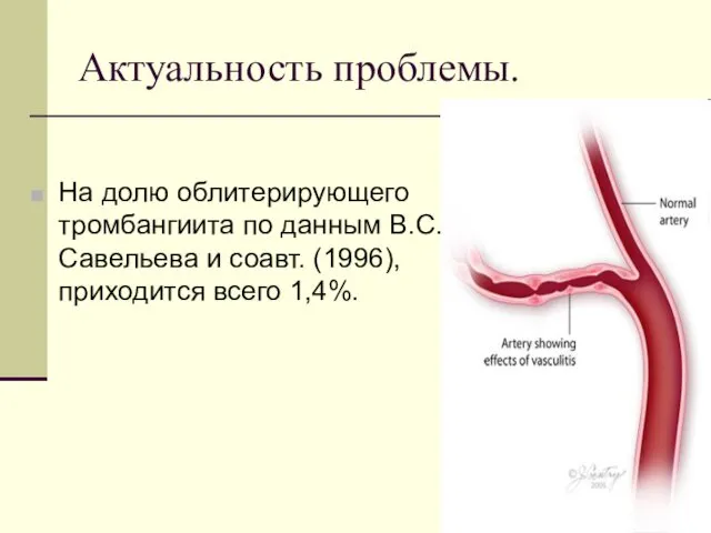 На долю облитерирующего тромбангиита по данным В.С.Савельева и соавт. (1996), приходится всего 1,4%. Актуальность проблемы.