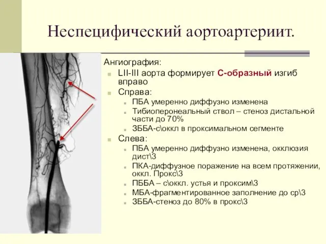 Ангиография: LII-III аорта формирует С-образный изгиб вправо Справа: ПБА умеренно диффузно изменена Тибиоперонеальный