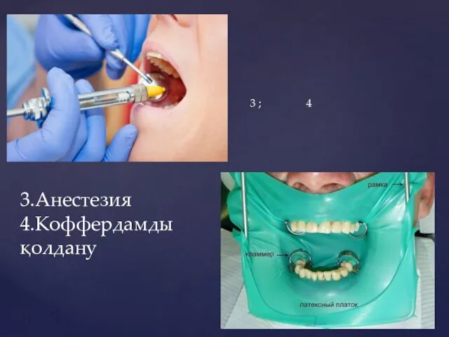 3 ; 4 3.Анестезия 4.Коффердамды қолдану