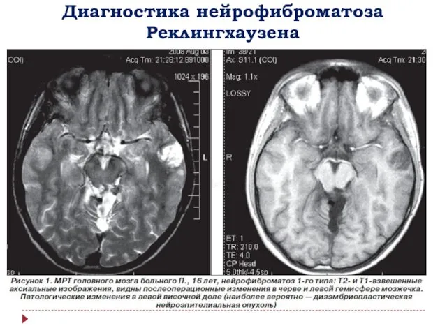 Диагностика нейрофиброматоза Реклингхаузена Для определения локализации опухолей при нейрофиброматозе Реклингхаузена
