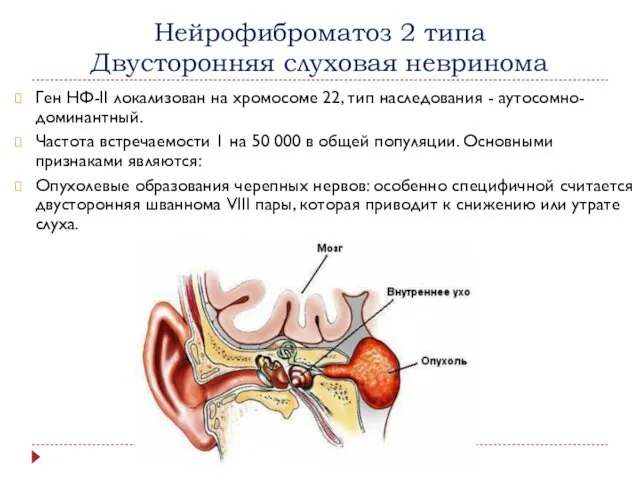 Нейрофиброматоз 2 типа Двусторонняя слуховая невринома Ген НФ-II локализован на