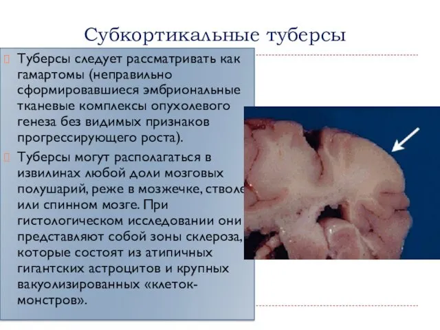Субкортикальные туберсы Туберсы следует рассматривать как гамартомы (неправильно сформировавшиеся эмбриональные