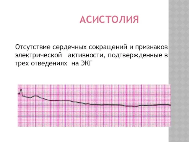 АСИСТОЛИЯ Отсутствие сердечных сокращений и признаков электрической активности, подтвержденные в трех отведениях на ЭКГ