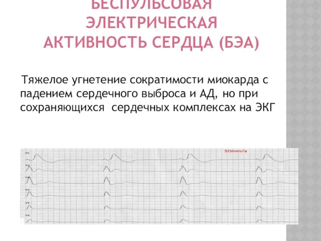 БЕСПУЛЬСОВАЯ ЭЛЕКТРИЧЕСКАЯ АКТИВНОСТЬ СЕРДЦА (БЭА) Тяжелое угнетение сократимости миокарда с