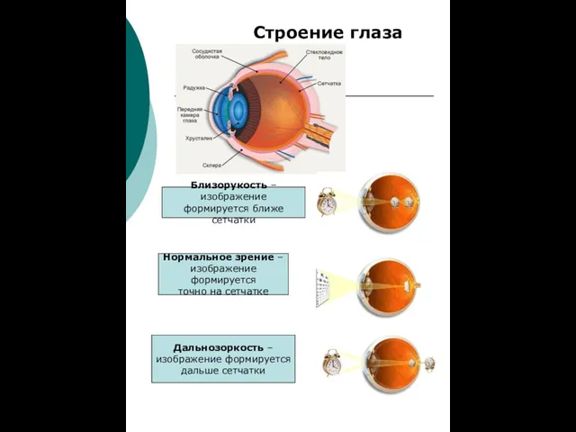 Близорукость – изображение формируется ближе сетчатки Нормальное зрение – изображение