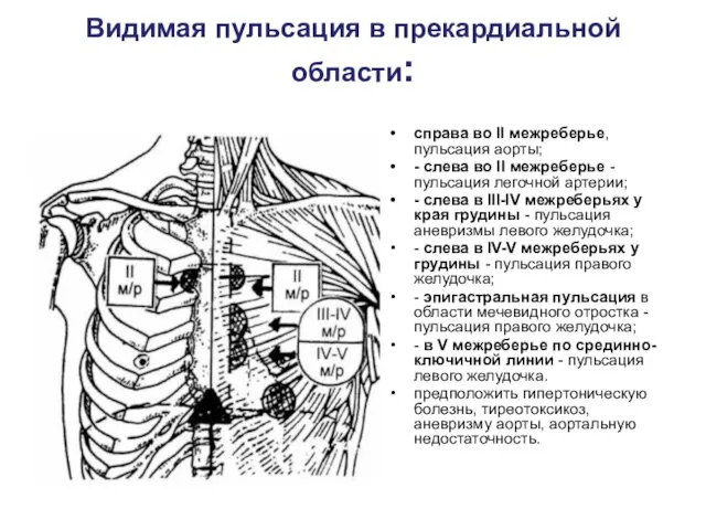 Видимая пульсация в прекардиальной области: справа во II межреберье, пульсация