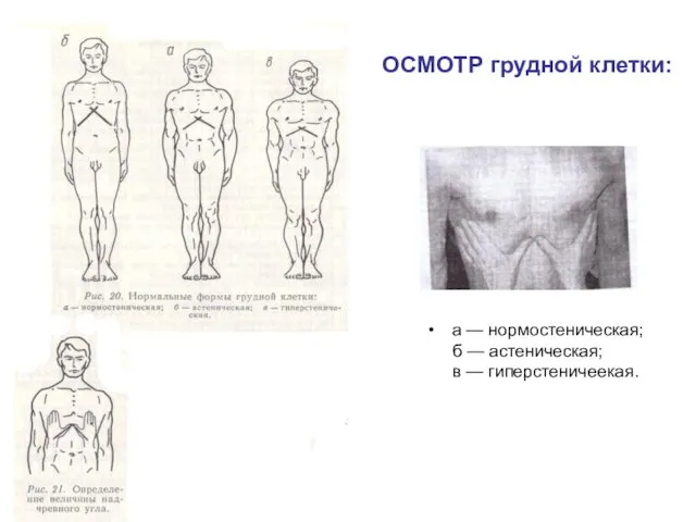 ОСМОТР грудной клетки: а — нормостеническая; б — астеническая; в — гиперстеничеекая.