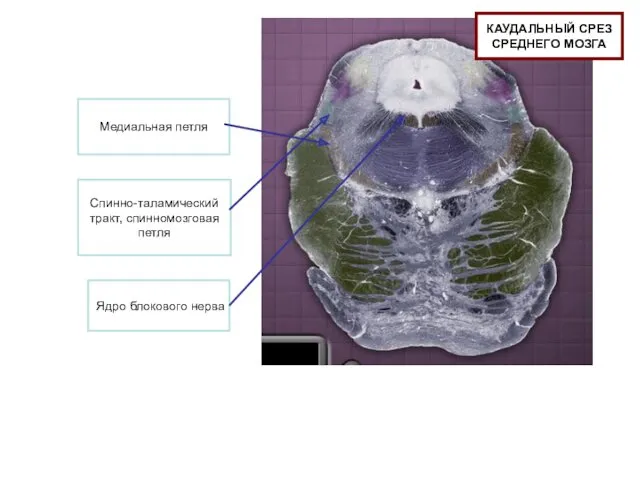 Медиальная петля Спинно-таламический тракт, спинномозговая петля Ядро блокового нерва КАУДАЛЬНЫЙ СРЕЗ СРЕДНЕГО МОЗГА
