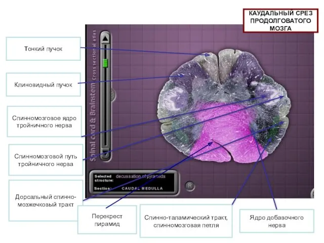 Тонкий пучок Клиновидный пучок Спинномозговое ядро тройничного нерва Спинномозговой путь