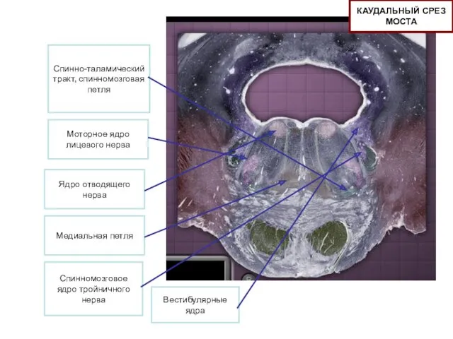 Спинно-таламический тракт, спинномозговая петля Медиальная петля Ядро отводящего нерва Моторное