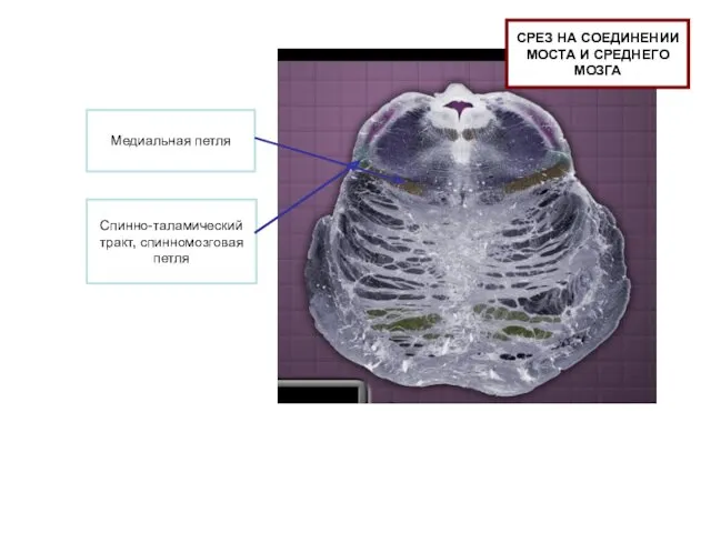 Медиальная петля Спинно-таламический тракт, спинномозговая петля СРЕЗ НА СОЕДИНЕНИИ МОСТА И СРЕДНЕГО МОЗГА
