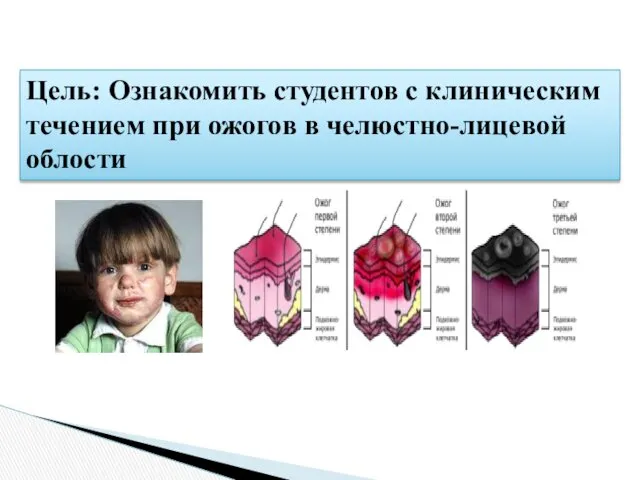 Цель: Ознакомить студентов с клиническим течением при ожогов в челюстно-лицевой облости