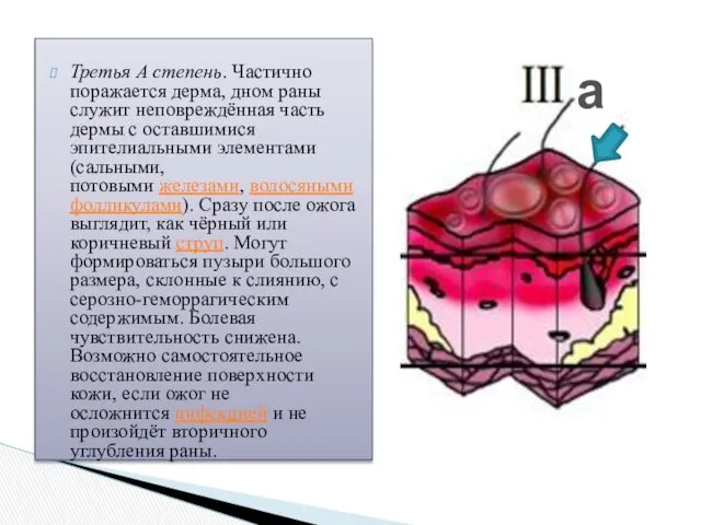 Третья А степень. Частично поражается дерма, дном раны служит неповреждённая