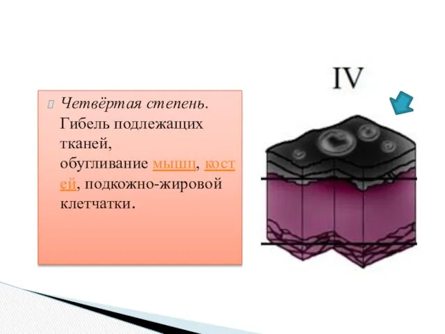 Четвёртая степень. Гибель подлежащих тканей, обугливание мышц, костей, подкожно-жировой клетчатки.