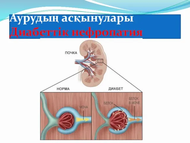 Аурудың асқынулары Диабеттік нефропатия