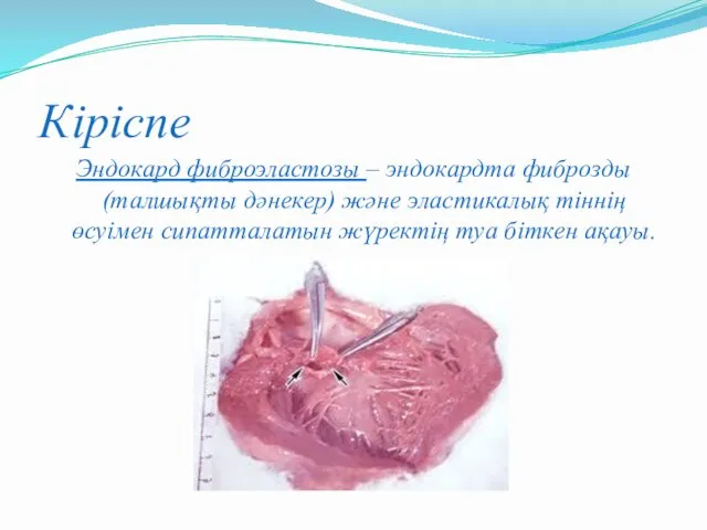 Кіріспе Эндокард фиброэластозы – эндокардта фиброзды (талшықты дәнекер) және эластикалық