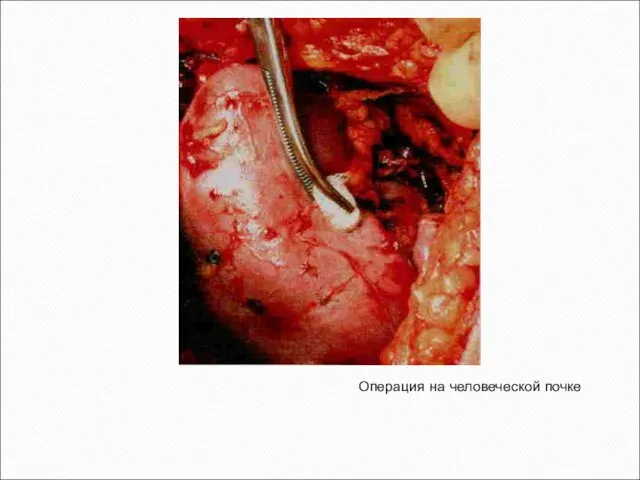 Операция на человеческой почке