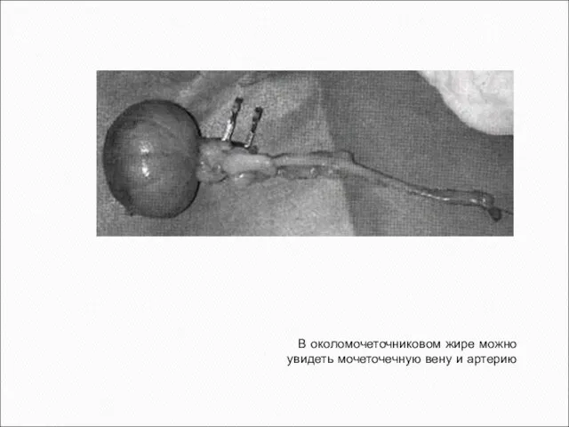 В околомочеточниковом жире можно увидеть мочеточечную вену и артерию