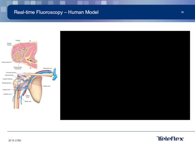 Real-time Fluoroscopy – Human Model