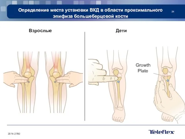 Определение места установки ВКД в области проксимального эпифиза большеберцовой кости Взрослые Дети Growth Plate