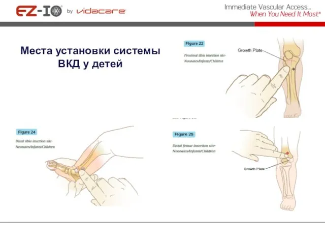 Места установки системы ВКД у детей