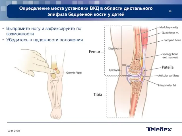 Определение места установки ВКД в области дистального эпифиза бедренной кости