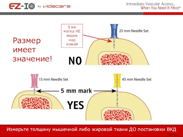 Измерьте толщину мышечной либо жировой ткани ДО постановки ВКД Note