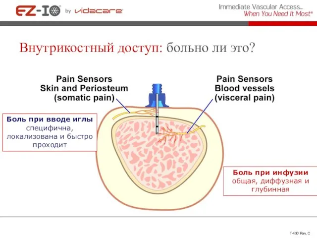 Внутрикостный доступ: больно ли это? T-430 Rev, C