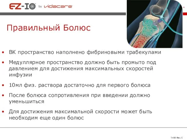 Правильный Болюс ВК пространство наполнено фибриновыми трабекулами Медуллярное пространство должно