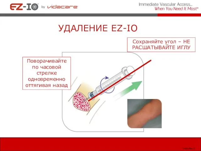 УДАЛЕНИЕ EZ-IO Сохраняйте угол – НЕ РАСШАТЫВАЙТЕ ИГЛУ Поворачивайте по