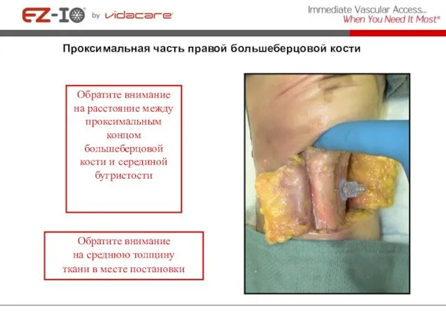 Обратите внимание на расстояние между проксимальным концом большеберцовой кости и